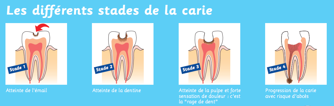 caries-evolution